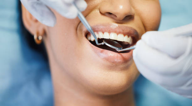 Best Emergency Wisdom Teeth Removal in Fort Dick, CA