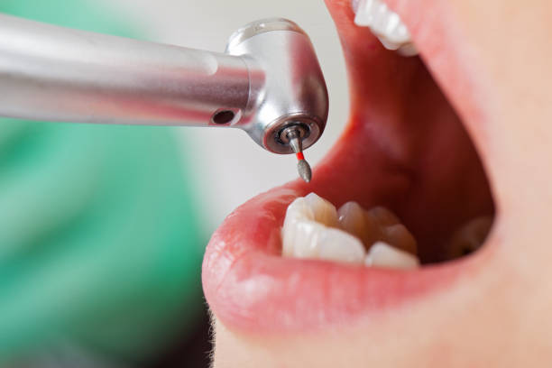 Best Emergency Treatment for Dental Infections or Abscesses in Fort Dick, CA